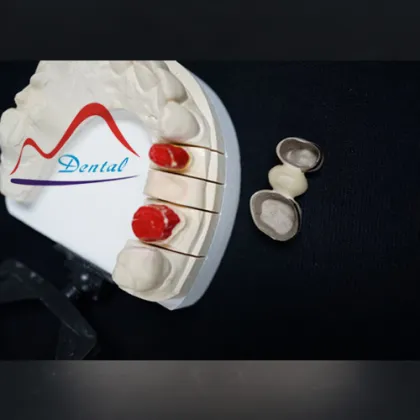 Strong dental Precious PFM