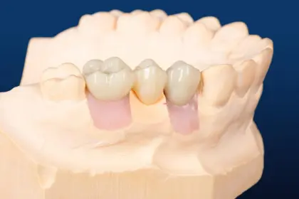 Custom Abutment with Two Brand New Screws