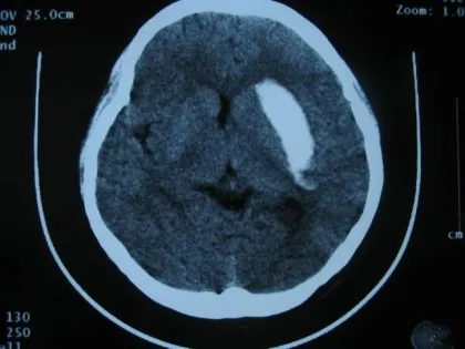 X Ray Medical Dry Film 10in×12in For Agfa Drystar