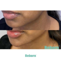 Injectable Neck Contouring Anti Wrinkles PLLA Dermal Filler