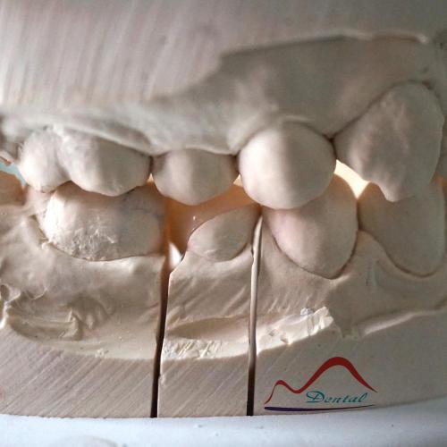 Dental Composite Resin Onlay