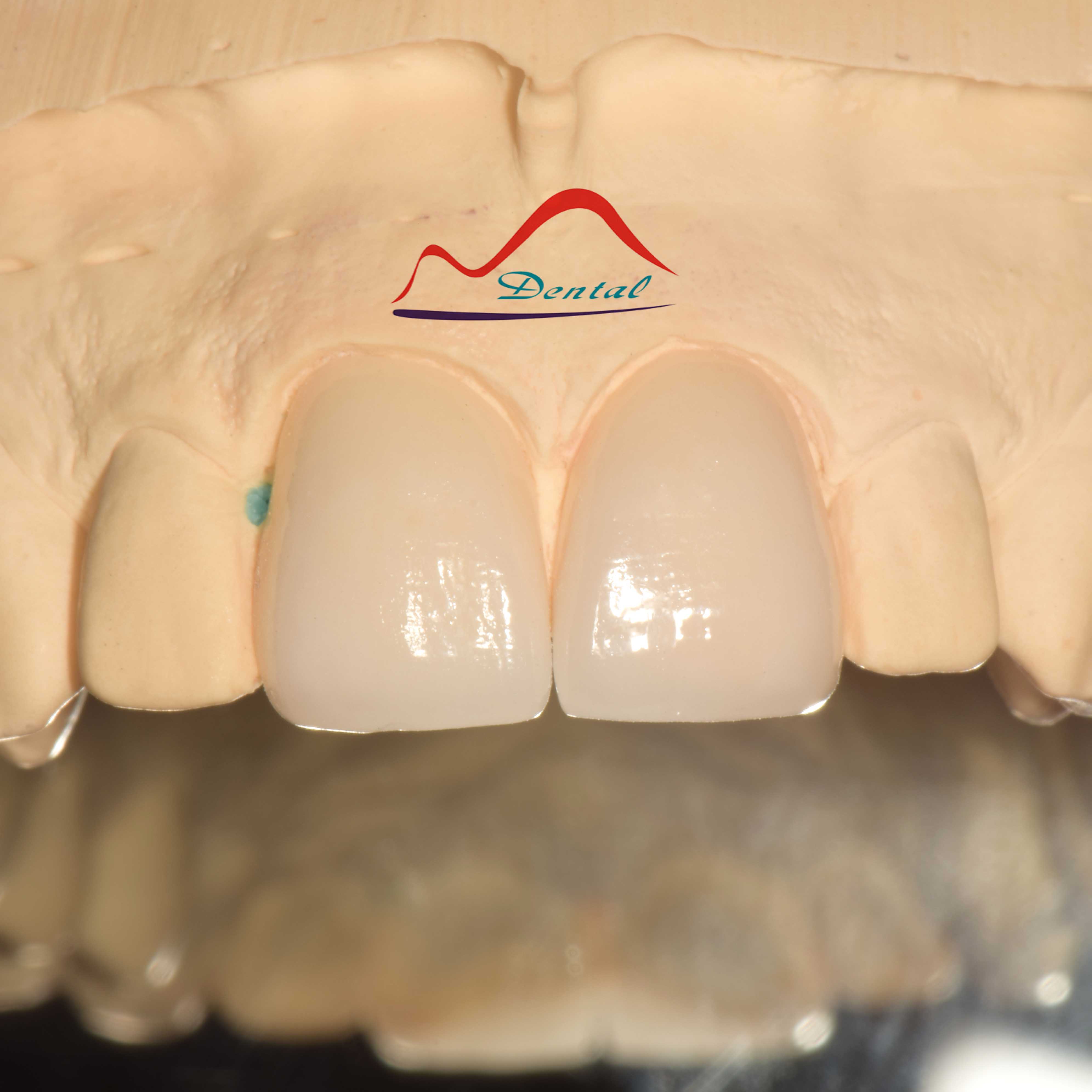 Dental Aesthetic Porcelain Veneers a