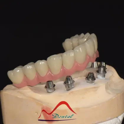 Malo Implant Bridge Restoration