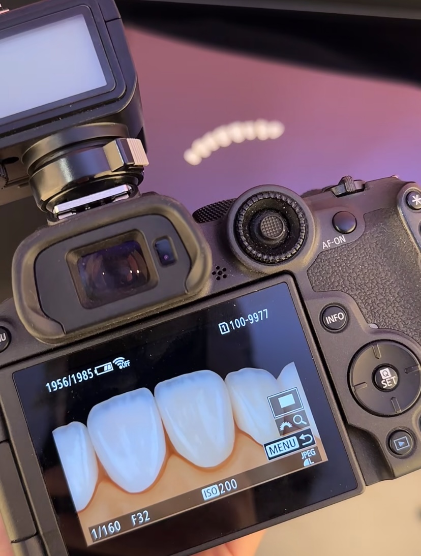 impiallacciature dentali dental veneers