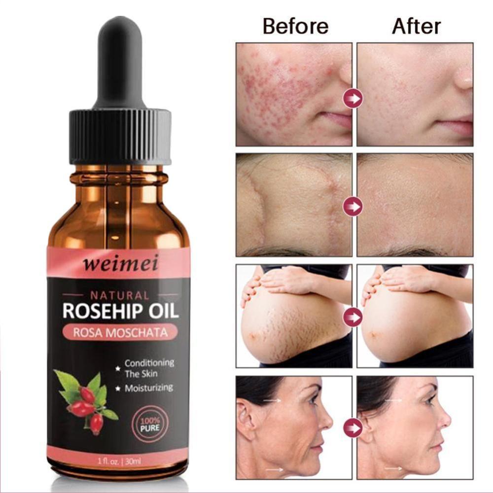 Organic Rosehip Seed Oil Moisturizing Brighten Skin Color Anti-Dry Anti-Aging Face Care Essential Oil