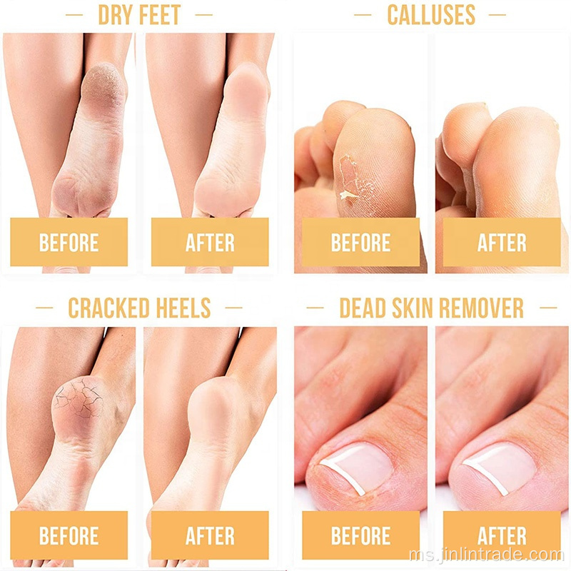Dermatologi diuji topeng kaki exfoliating