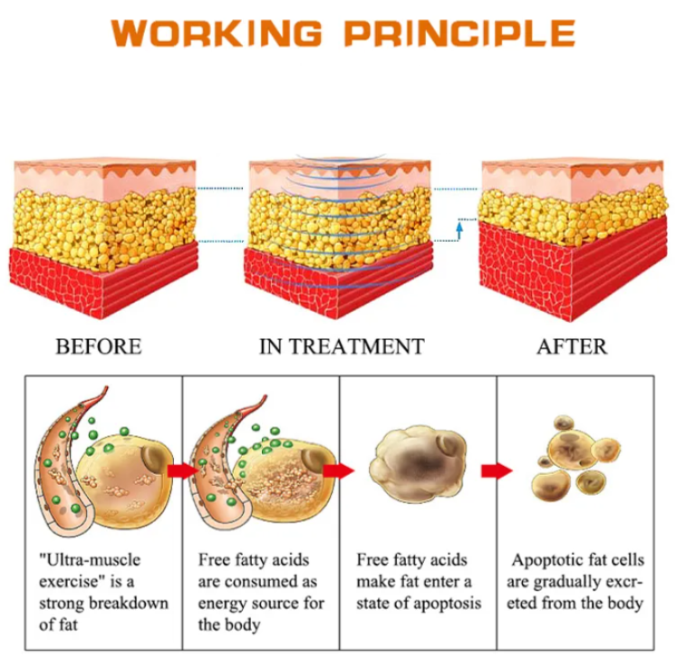 working principle of cryolipolysis