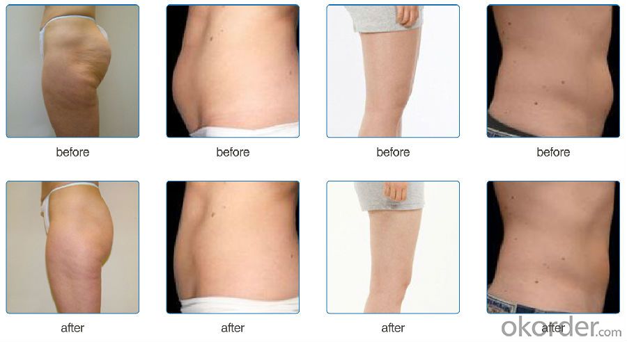 CHOUCY CAVITATION RF Slimming System