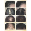 Acetil Tetrapéptido-3 promueve el extracto de crecimiento para el cabello