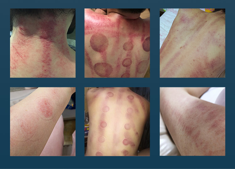 cavitation slimming system