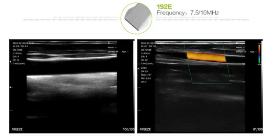 wireless wifi ultrasound 192E Linear