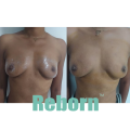 Natural Female Beauty Skin Care Breast Enlargement Filler
