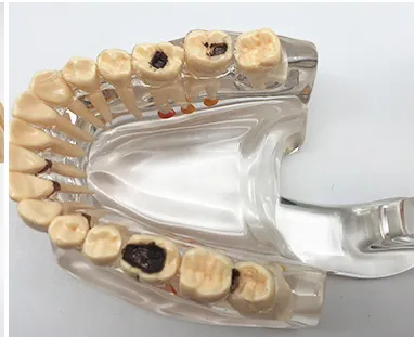 Orthodontic and Dental Pathological Teeth Model Restoration Study in Medical Science