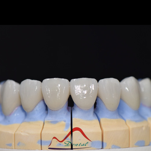 Aesthetics Zirconia Porcelain Bridge