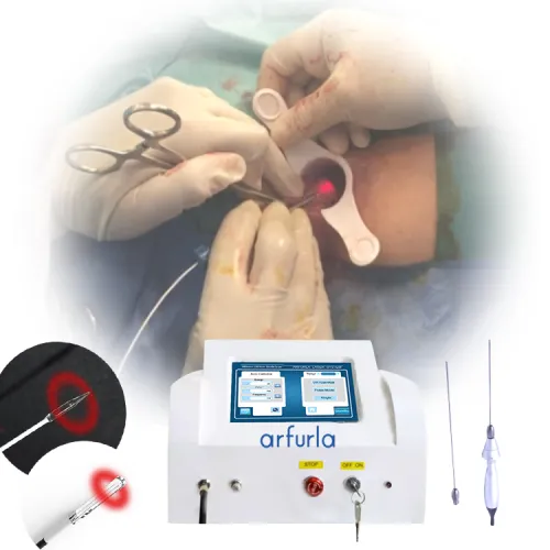 Hemorrhoids Treatment With Arfurla 1470nm Laser Device For Haemorrhoids