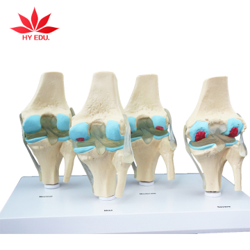 4-Stage Osteoarthritic Knee Model for Referential Pain Demonstration