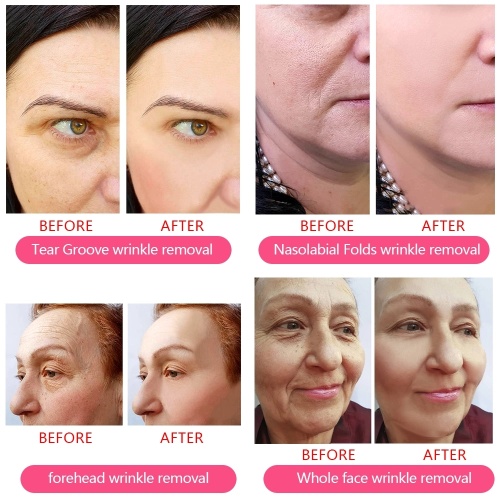 Sculptra Face Sculptra Aesthetic cosmetic sculptra filler forcheeks jowls face lips lift Manufactory