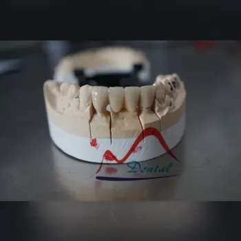 One of the most durable all non-metal restoration Zirconia