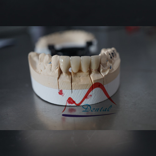 One of the most durable all non-metal restoration Zirconia