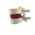 Lumbar Disc Herniation Demonstration Model