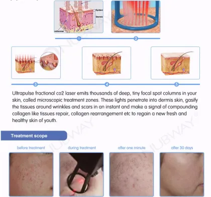 medical fractional laser co2 Vaginal tightening
