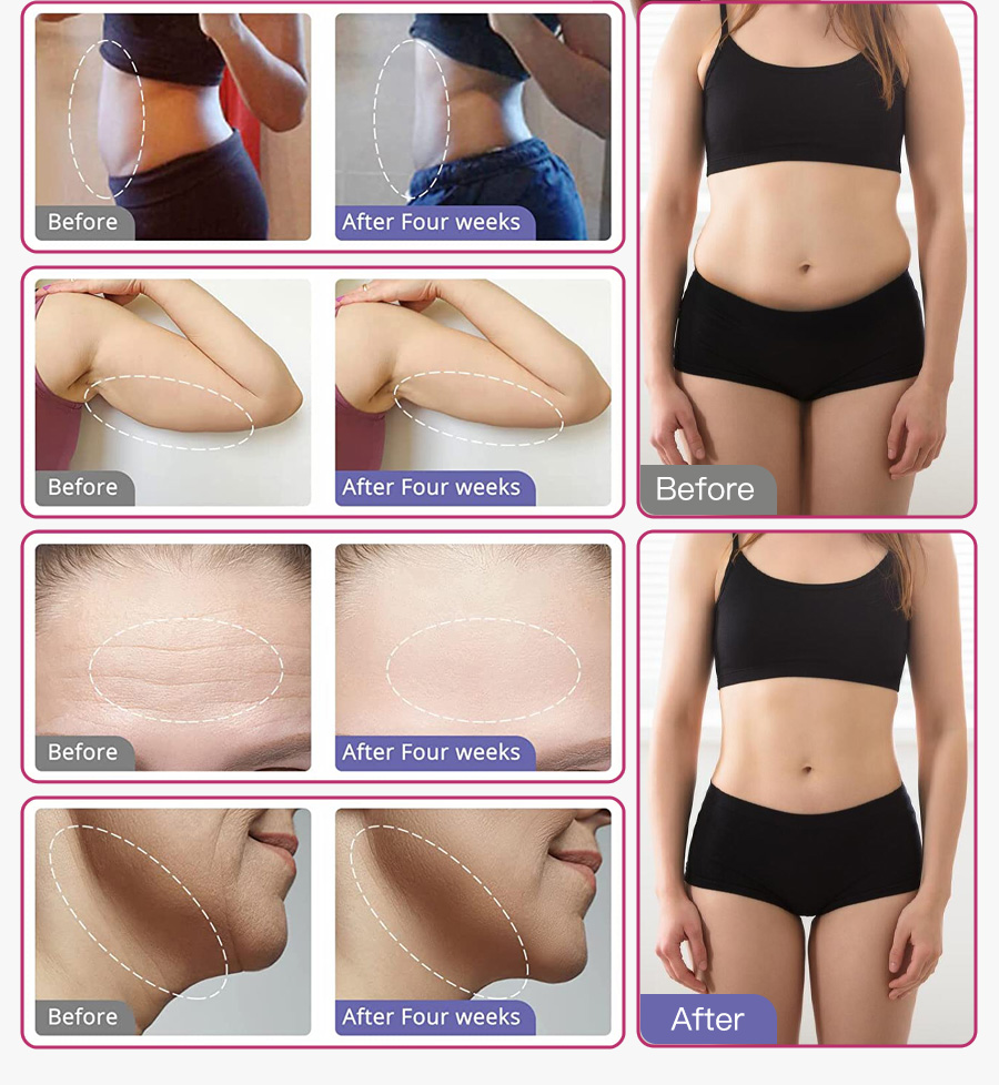 Omeina cavitation and rf