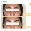 Fine Lines Removal Dermal Filler For Sagging Upper Eyelids