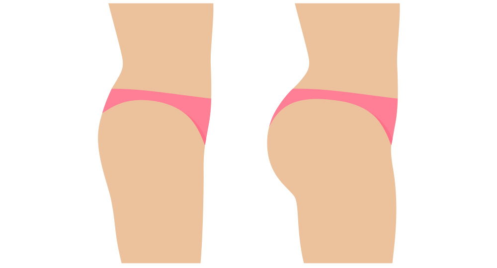 Reborn PLLA para el trasero brasileño Reborn PLLA for Brazilian Butt Lift