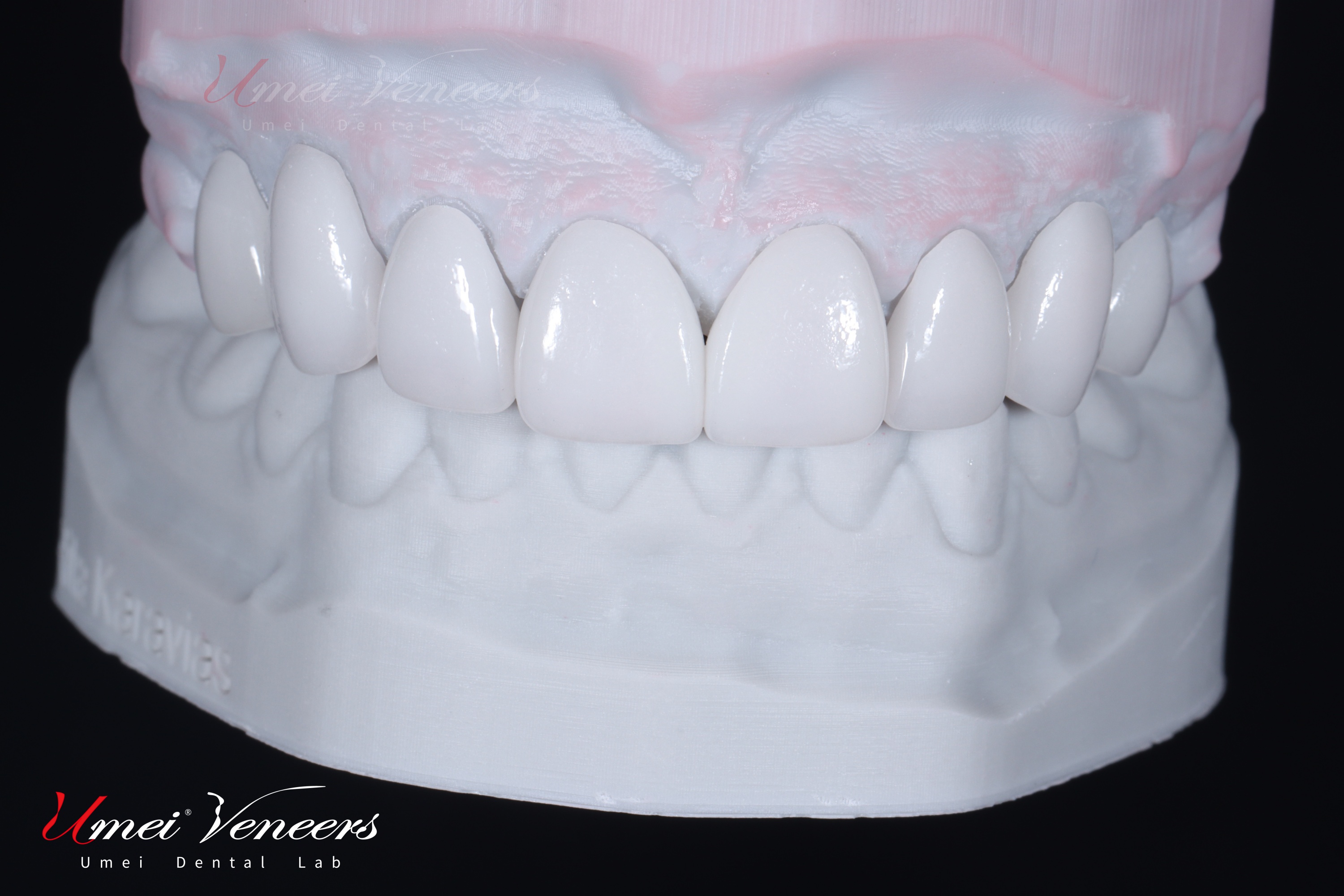Καπλαμάδες ζιρκονίας Zirconia Layered Veneers