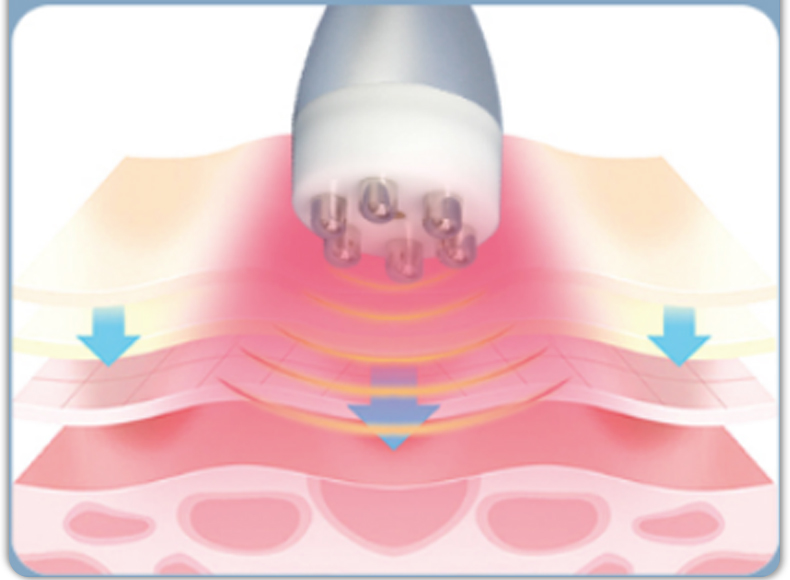 rf+lipolaser