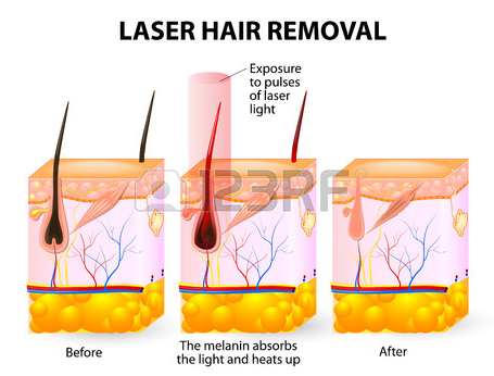 Mânerul de îndepărtare a părului cu laser 350W de 350W 808nm