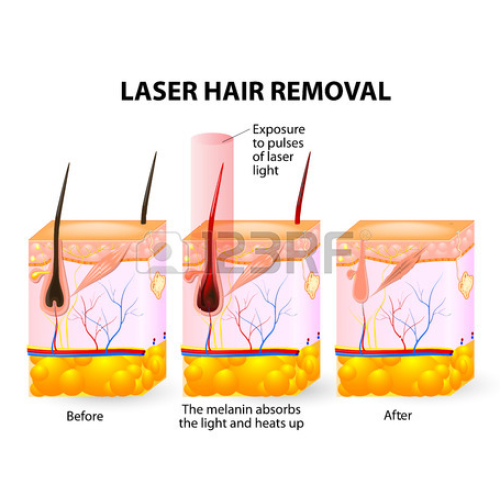 Diode Laser Hair Removal Gel Choicy 350W 808nm Diode Laser Hair Removal Handle Manufactory