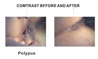 Anorectal Treating Device LG2000b for Hemorrhoids Surgery