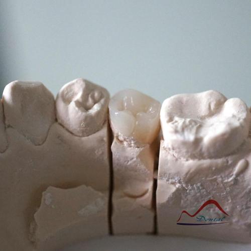 Dental Composite Resin Onlay
