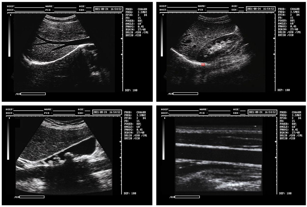 B ultrasound scanner