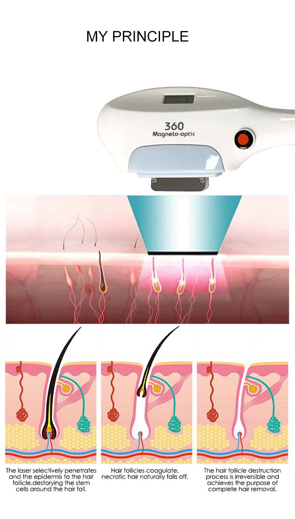 hair removal device