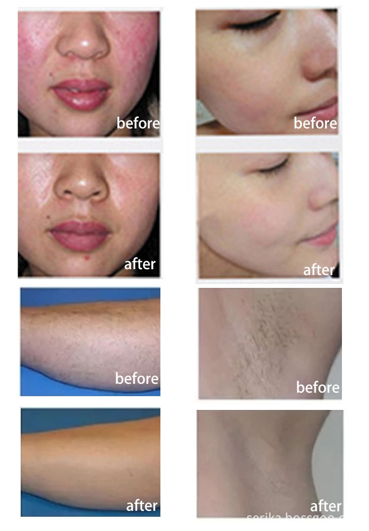Ipl Epilator