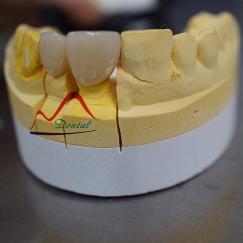 Zirconia bridge layered with wings 