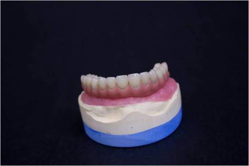 Implant Porcelain Teeth