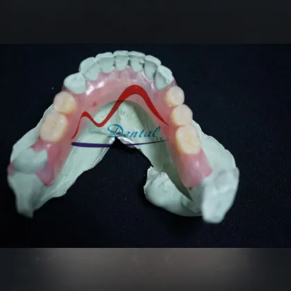 Mega Valplast Flexible Denture