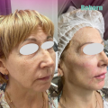 Skin Care Poly-l-Lactic Acid Aesthetics Anti Wrinkles Filler