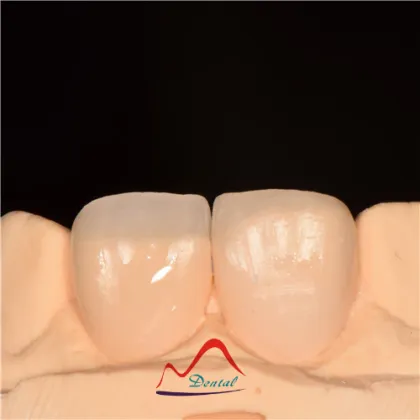 Dental All Ceramics CC Veneers