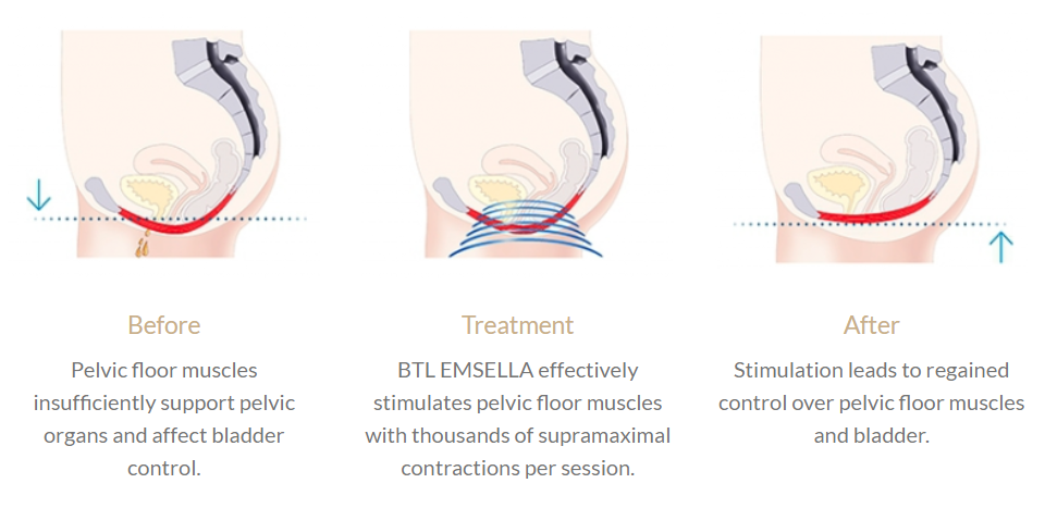 Ems Chair Women Exercise Muscle Pelvic Floor Muscle Repair Buttock Lift EMS stimulate Chair