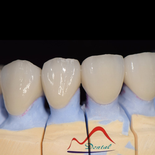 Aesthetics Zirconia Porcelain Bridge