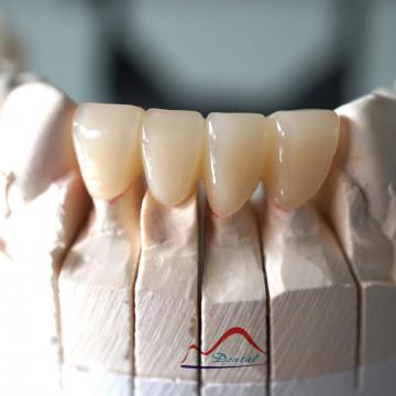 Anterior IPS Emax Press Bridge