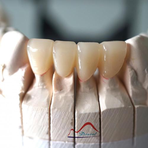 Anterior IPS Emax Press Bridge
