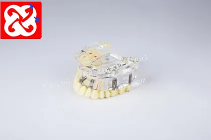 Dental Model Upper Half: Implant and Restoration