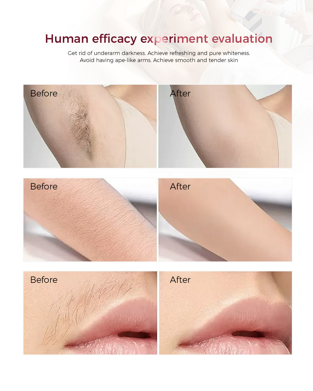 laser hair removal