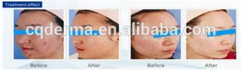 acne vulgaris Treatment/improvement/reduction and skin rejuvenation
