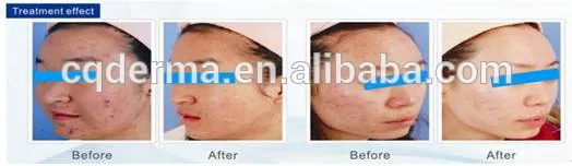 acne vulgaris Treatment/improvement/reduction and skin rejuvenation
